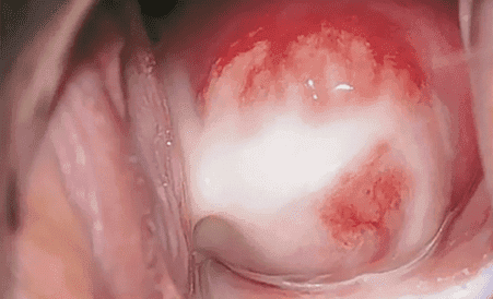 cervix with gonorrhea