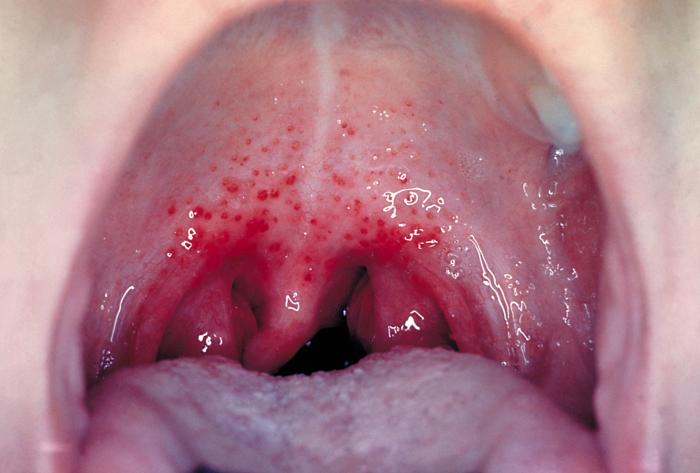 Image of Strep Throat
