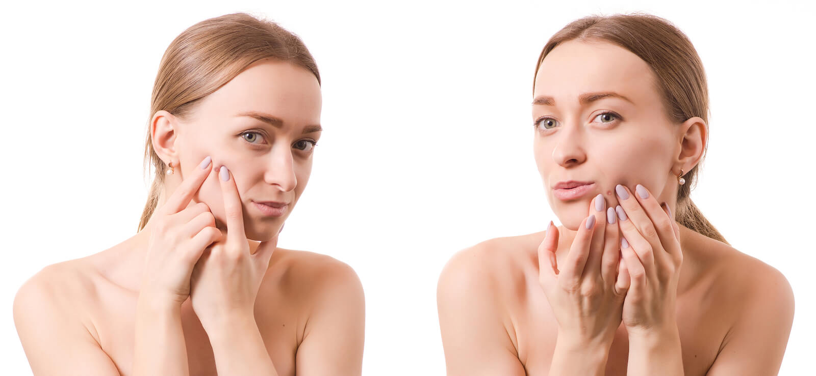Cold Sore or Pimple? How to Spot the Difference