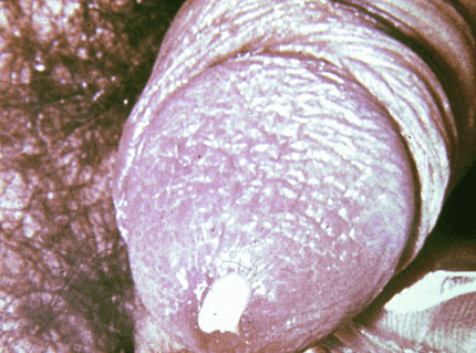Gonorrhea_In_Men__