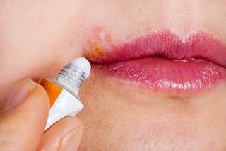 cold-sores-vs-herpes