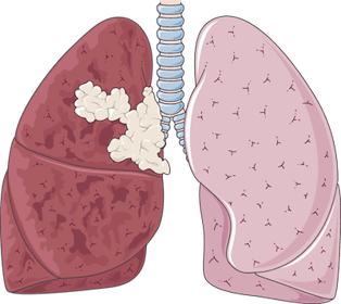 Pictures of Lungs After Quitting Smoking