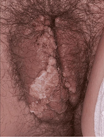 hpv_in_women