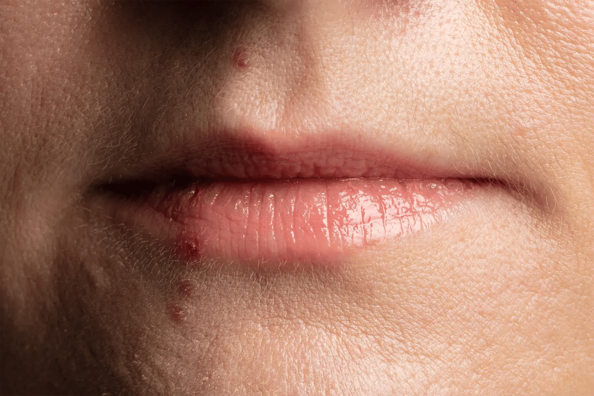 What does herpes look like