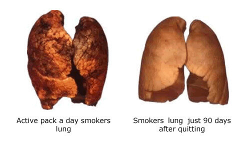 Pictures of Lungs After Quit Smoking & How We Can Help