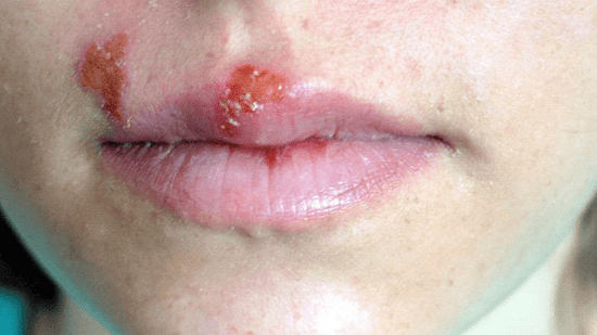 oral_herpes