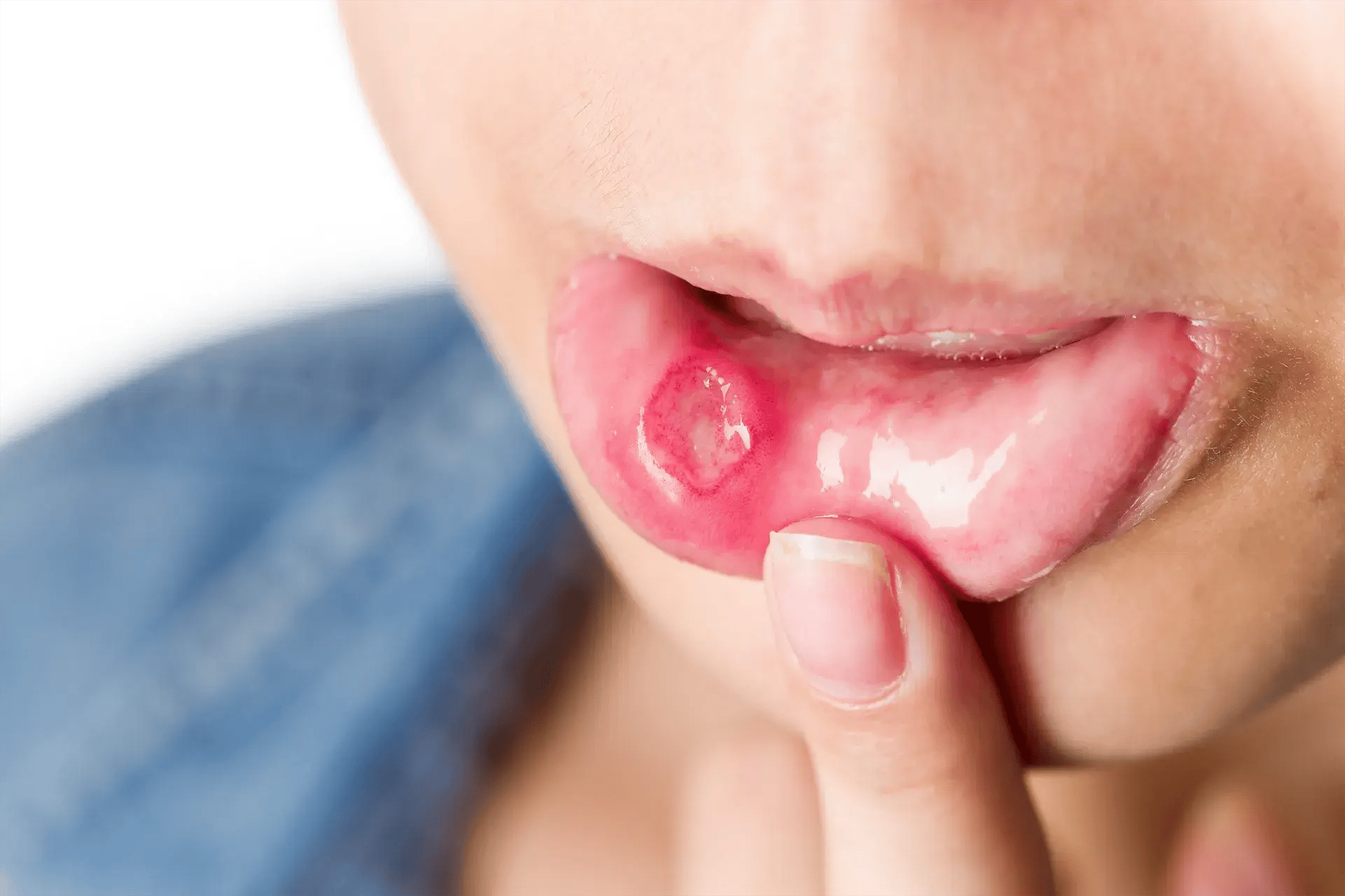 Cold Sore