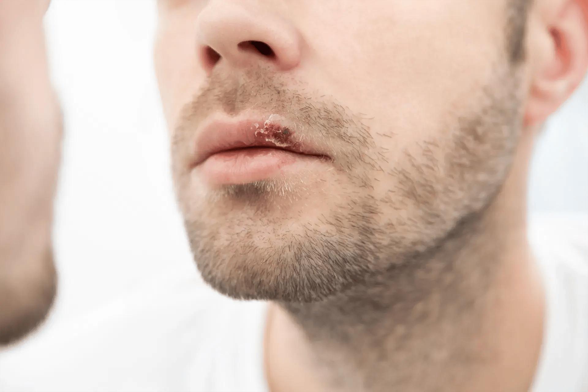 Oral herpes