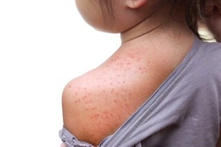 amoxicillin-rash